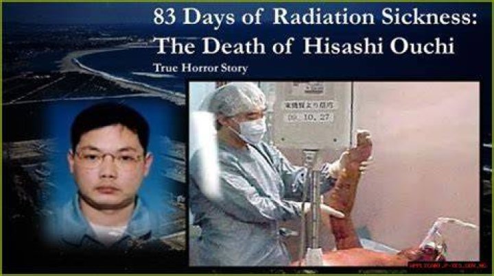 Hisashi Ouchi And The Legacy Of Radiation Exposure